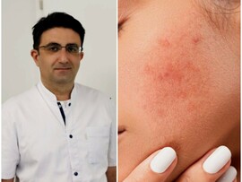 إحمرار الوجه قد لا يكون صحياً بل مرض "الوردية"